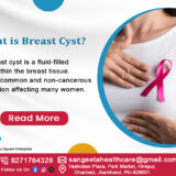 Breast Cysts